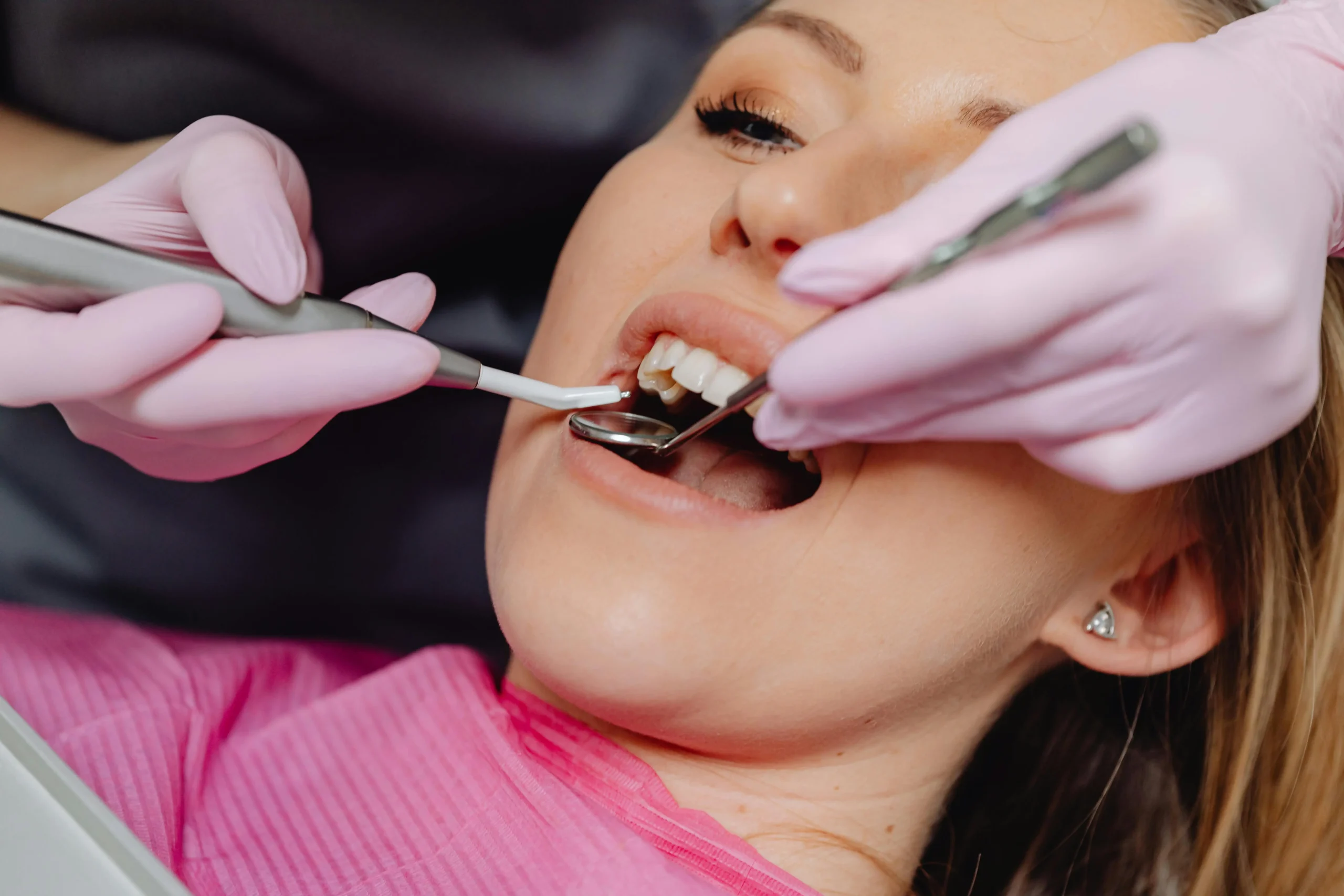 Injerto de Hueso Dental Todo lo que debes saber en 2024